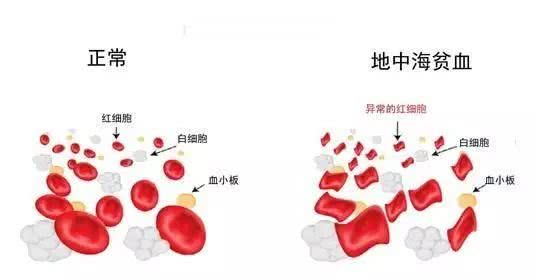 地中海贫血者买哪个险种好？还能买到重疾险吗？插图