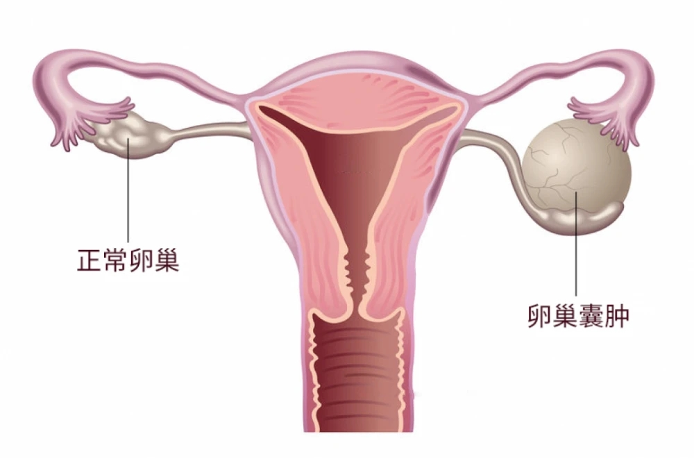 患有子宫肌瘤、宫颈炎等女性疾病，还能买保险吗？有什么保险可以选？插图6