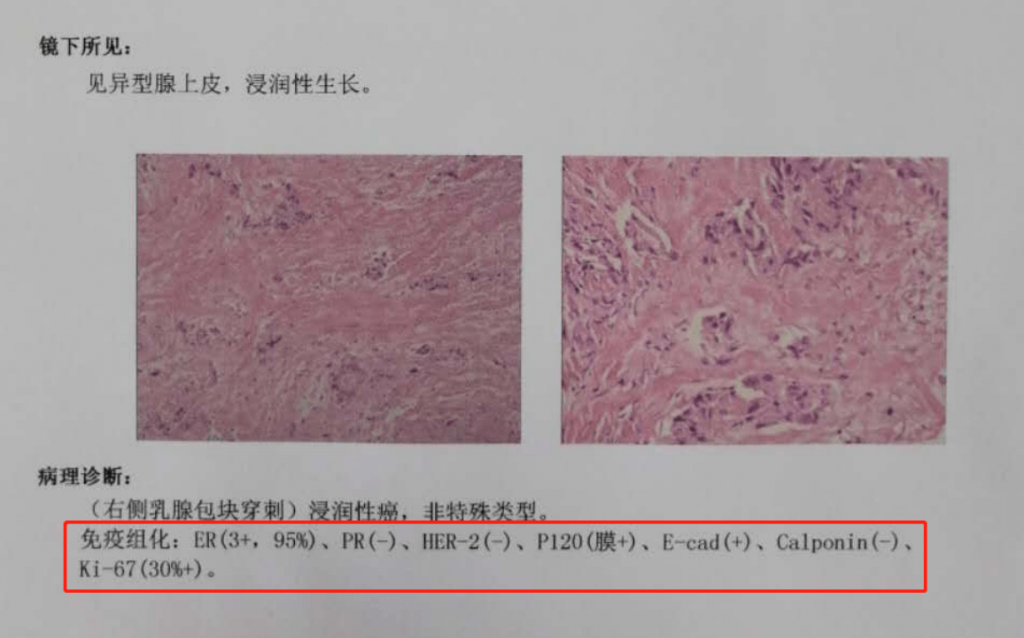 得过乳腺癌也能买的保险,你知道吗?插图 得过乳腺癌也能买的保险,你知道吗?插图