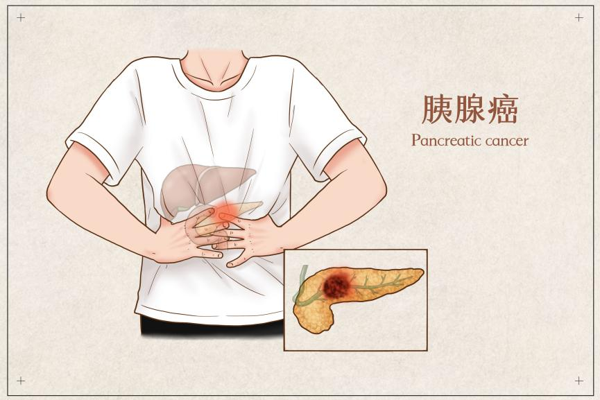 这种癌症一查出就是晚期？5个早期信号千万要留意插图