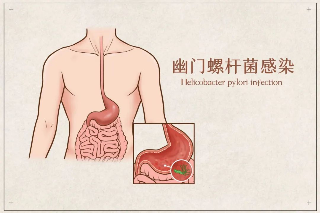 家庭平均感染率超70%，Hp阳性影响买保险吗？插图4