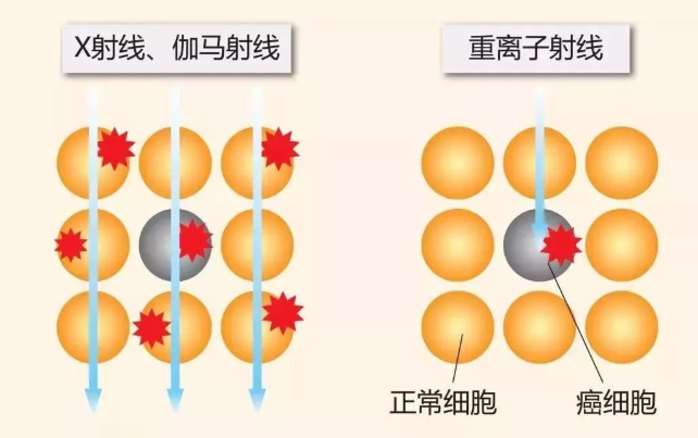 号称“癌症克星”的质子重离子治疗到底是什么？需要多少费用？插图12