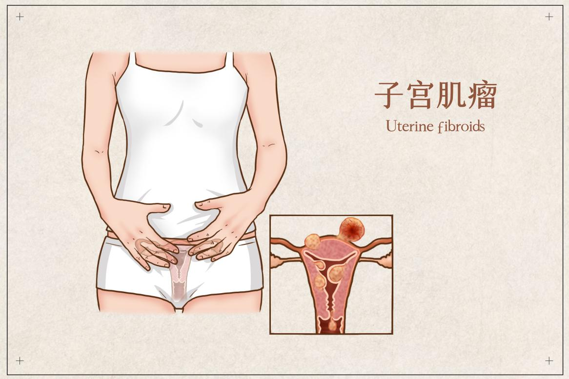 子宫肌瘤做手术，百万医疗险能报销吗？插图2