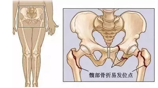 只是摔了一跤，终身瘫痪在床……插图2