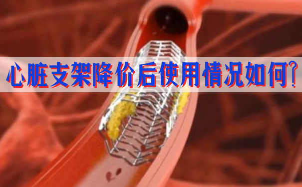 降价后心脏支架的使用情况如何？插图