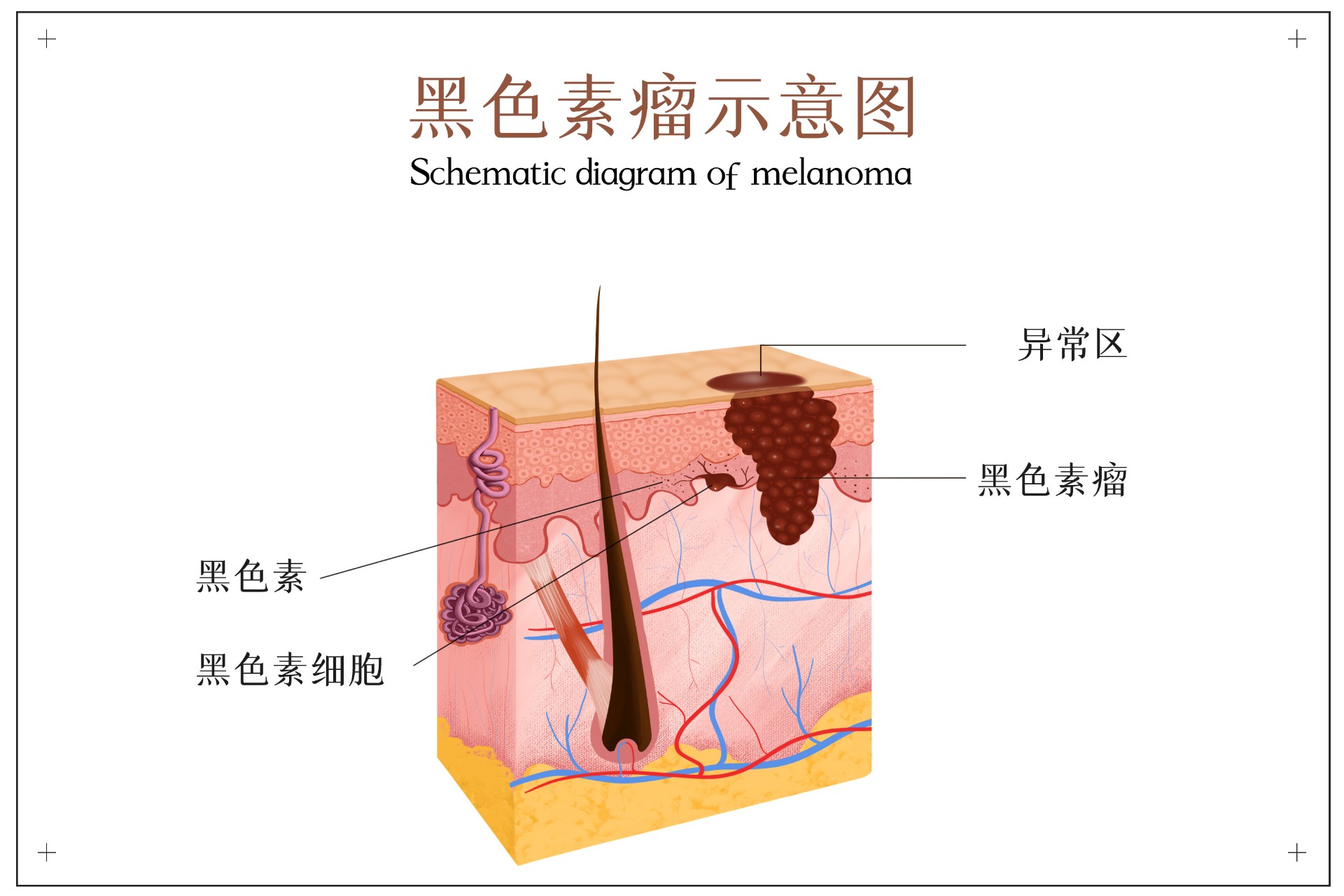 身上的痣，变成黑色素瘤的可能性大吗？插图3