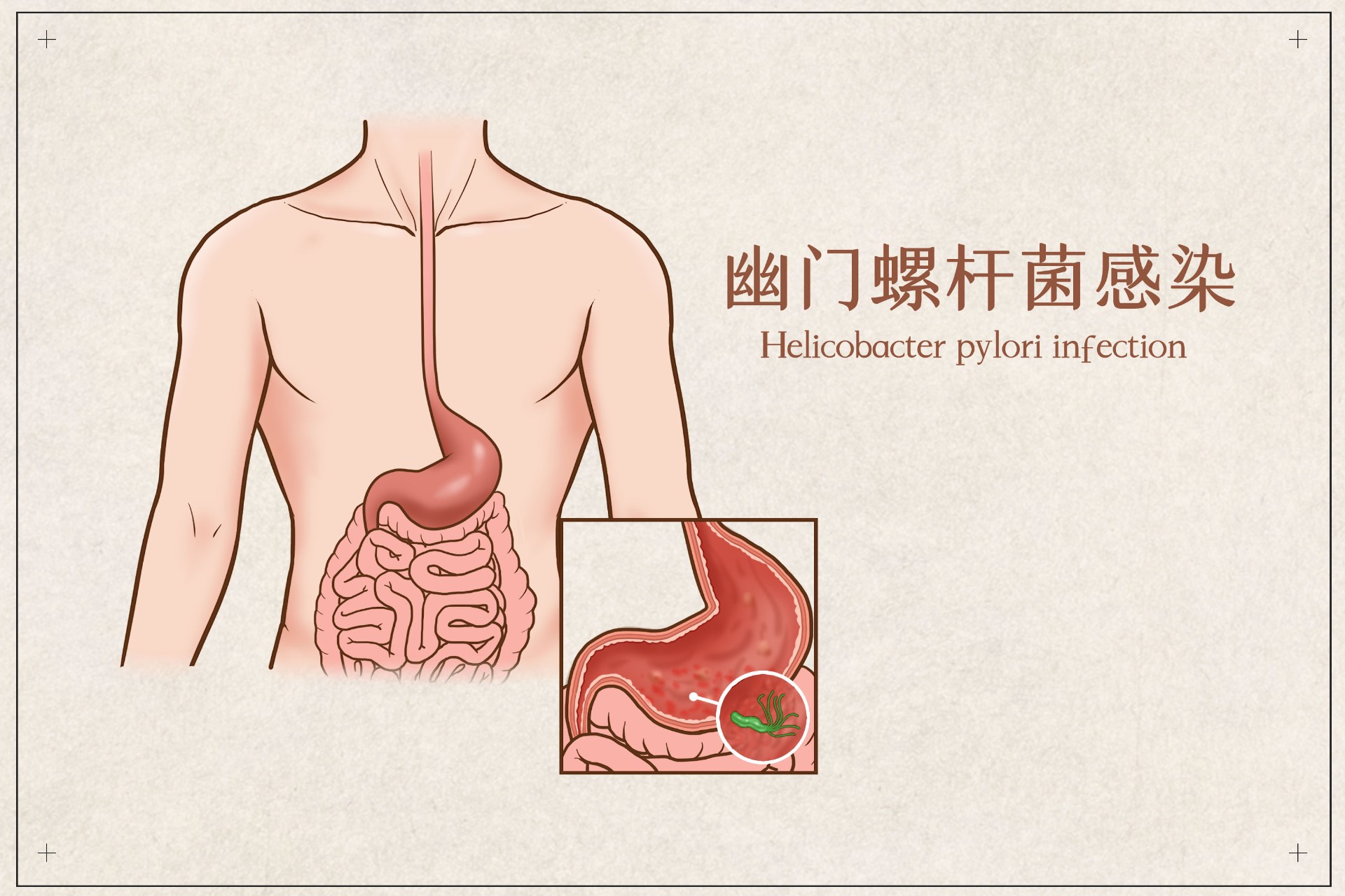 幽门螺杆菌怎么传播的？有什么症状？插图3