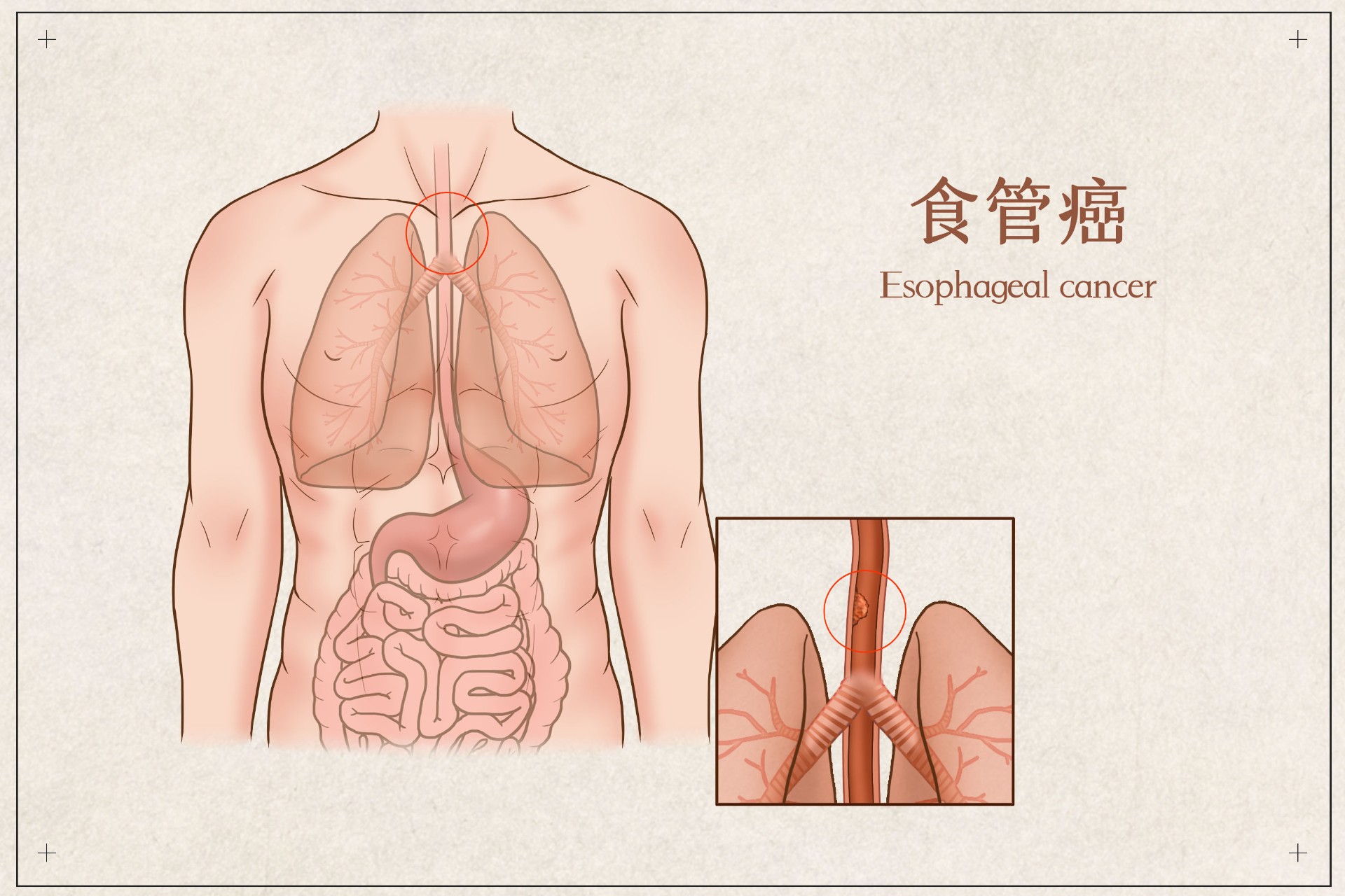 不幸得食管癌，保险赔吗？插图3